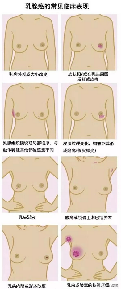 乳腺癌發生轉移了，手術還有意義嗎？