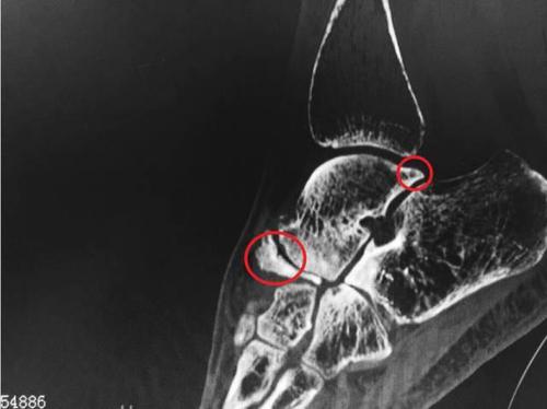 膝關節滑膜炎用什么膏藥好